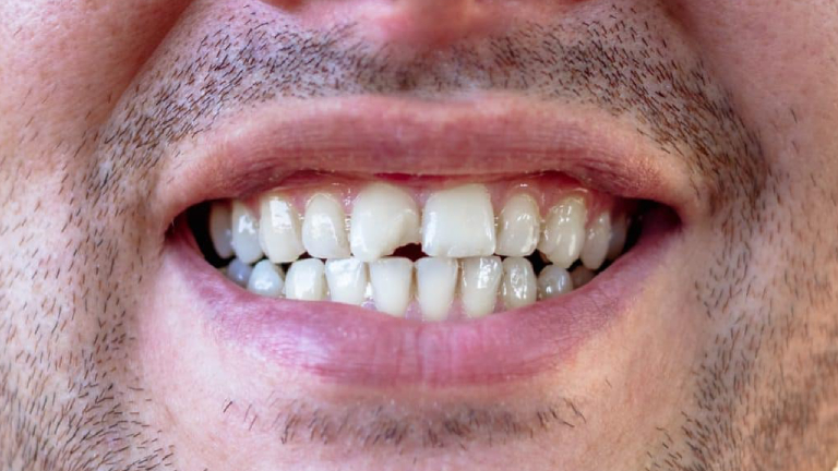 Chipped or Cracked Tooth